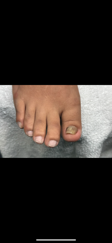 Light Fungus Wellness Pedis