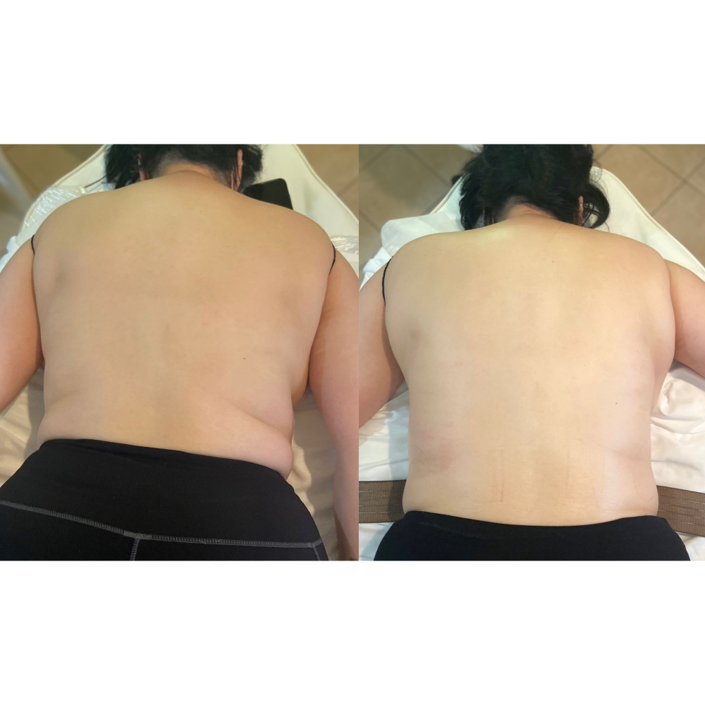 Back Caviation + Skin Tightening