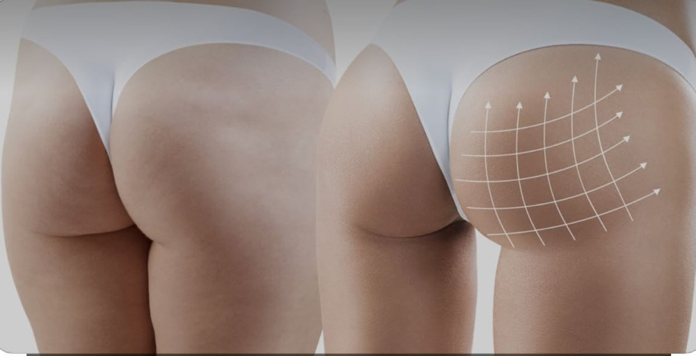 Hyaluron Pen Butt Filler Class