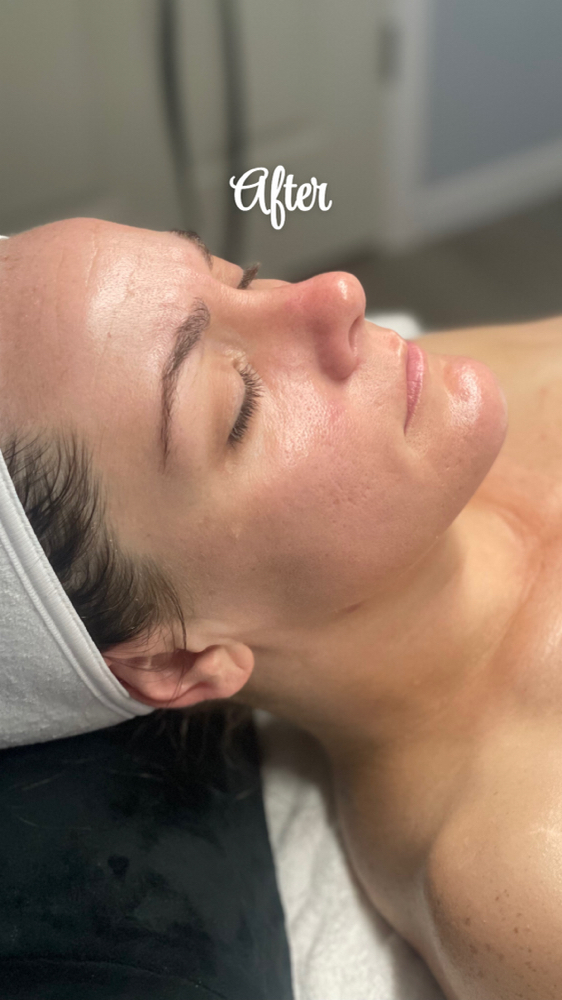 Dermaplaning Facial