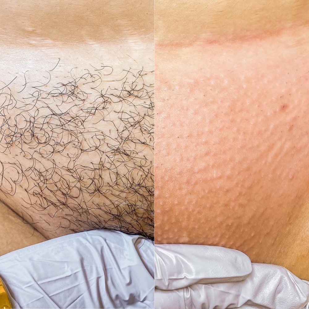 Brazilian Wax (only WOMEN)