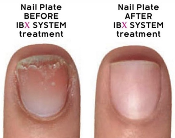 IBX Treatment