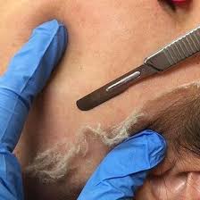 Dermaplaning Facial