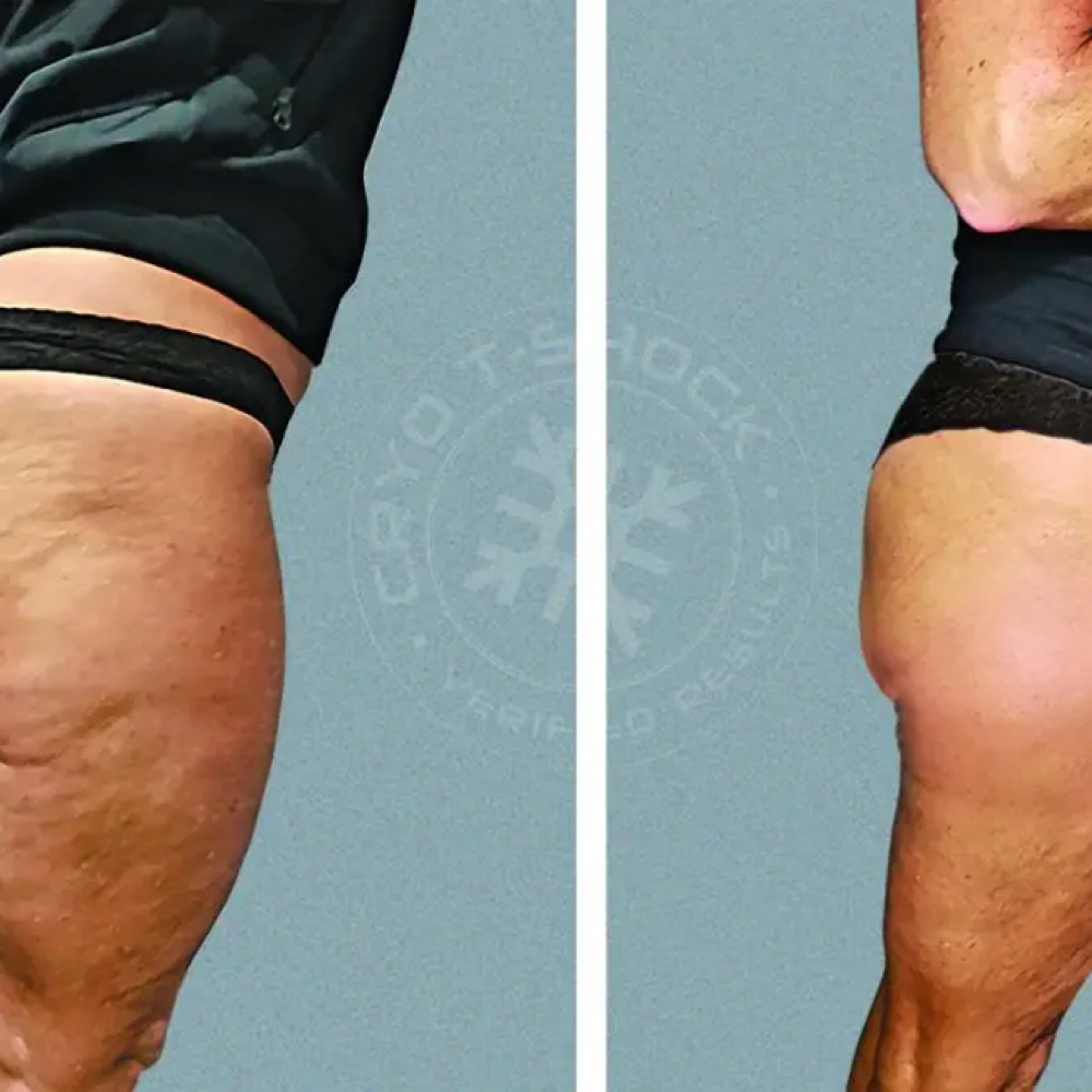 Cryo T-Shock Cellulite Reduction