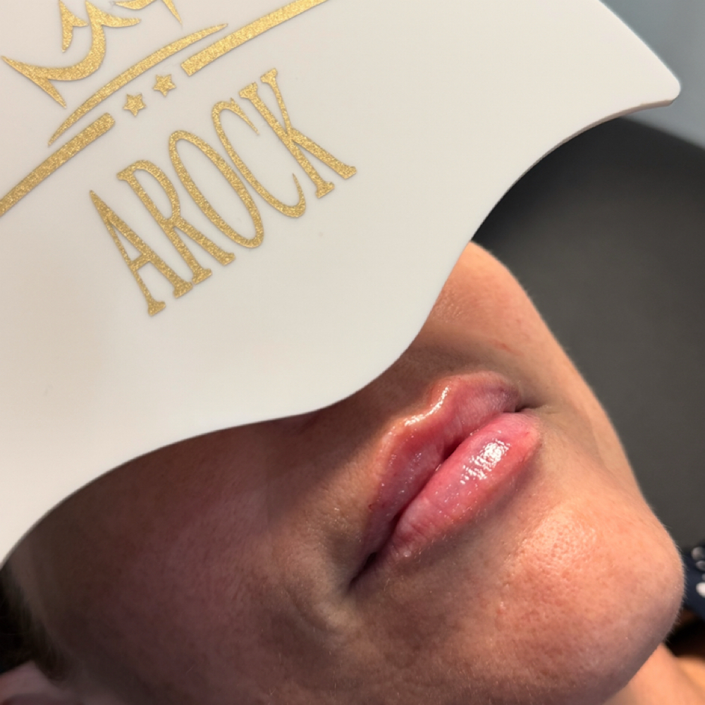 Lip Filler at ARock Beauty & Wellness in San Angelo, TX