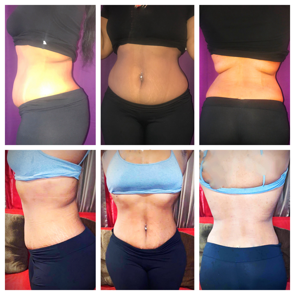 Stomach & Back Injections