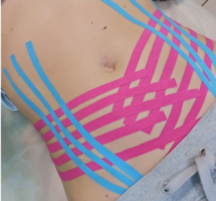 KT Taping | Skin Retraction