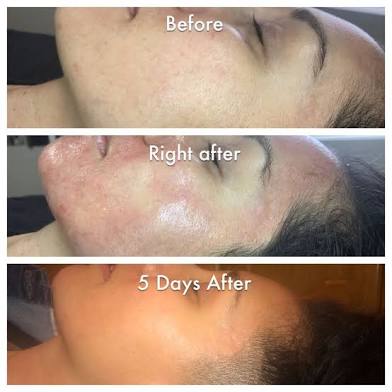 nano-needing facial