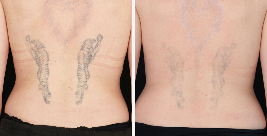 Non Invasive Tattoo Removal