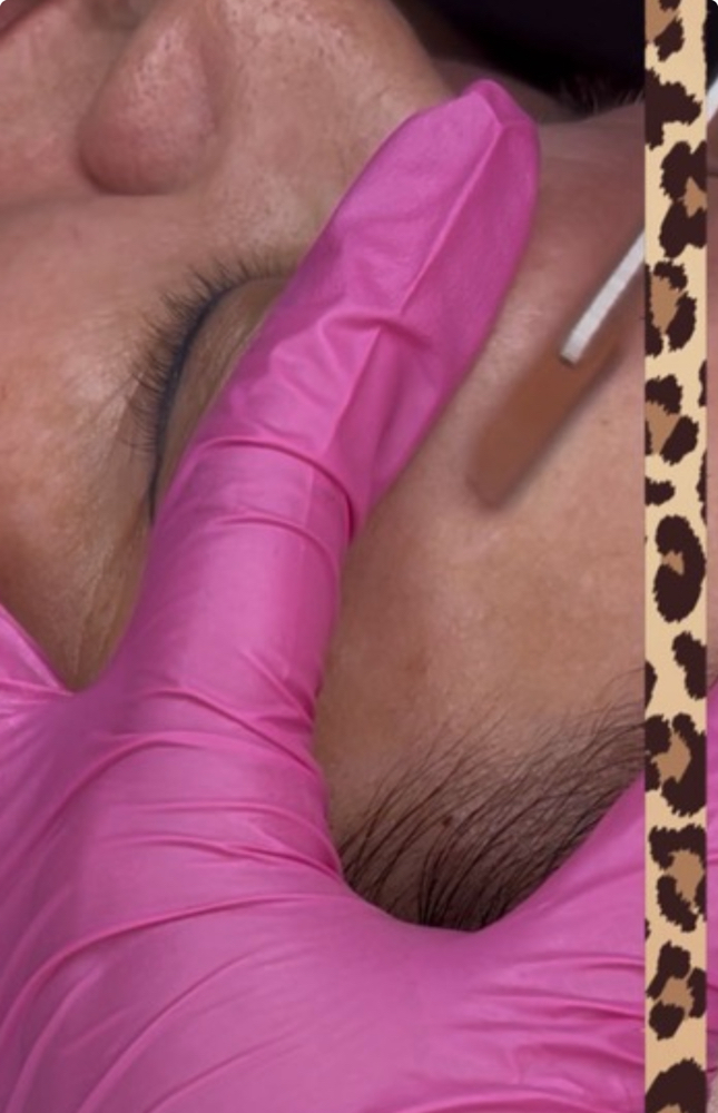 Accelerated Dermaplane