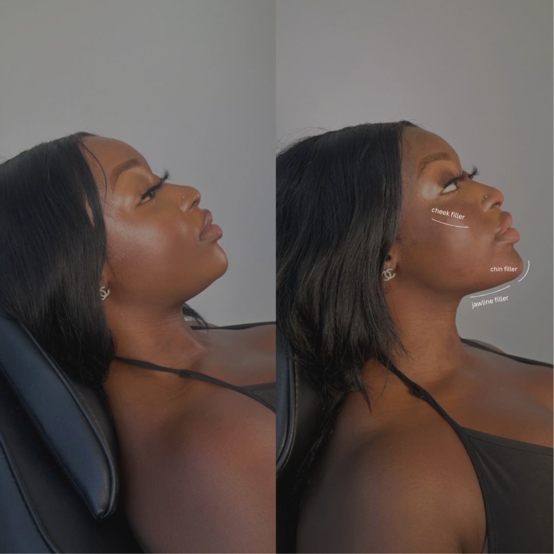 Filler at Plush Lash + Era Aesthetics in Alexandria, VA