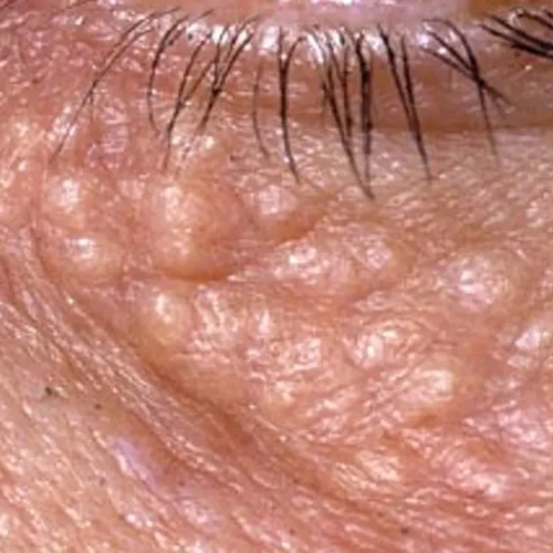 Syringoma Removal at Serenity Aesthetics by Denise in St. John’s, FL