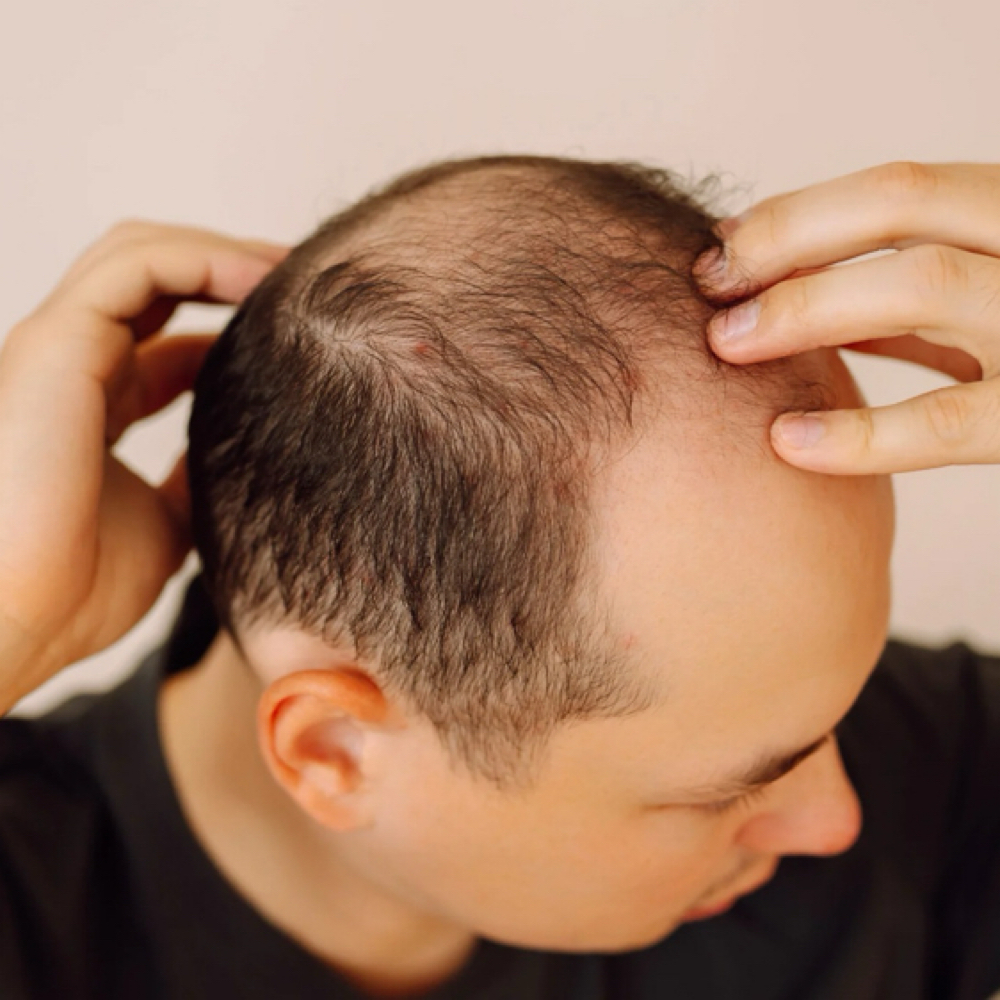 Scalp microneedling at Perma Glow Shanna in Elmhurst, NY