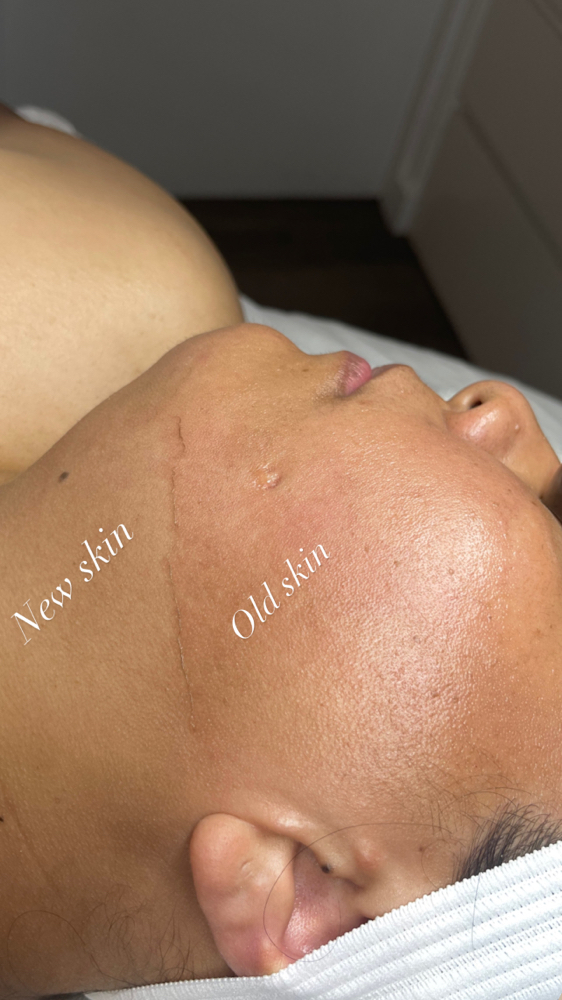 The Dermaplaning Facial