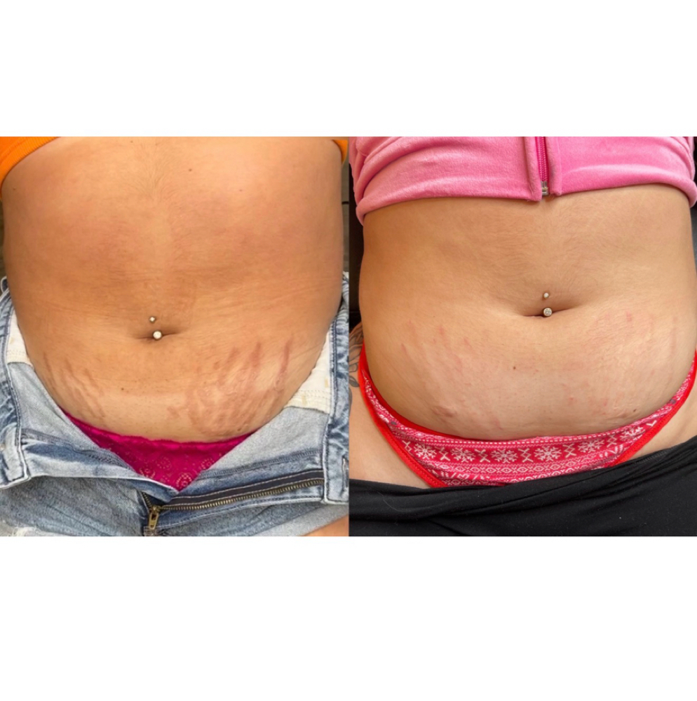 ISR Treatment at Brow Logic in Dunedin, FL