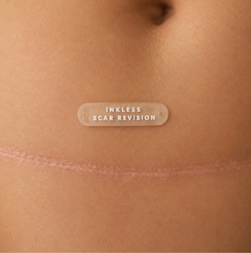 Inkless Scar Revision at Brow Logic in Dunedin, FL