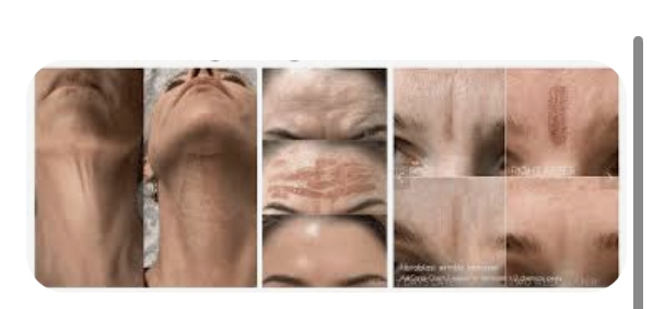 Fibroblast