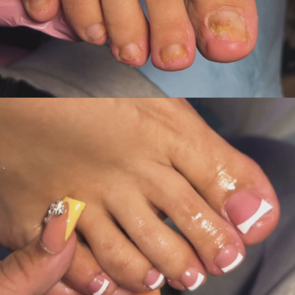 POLYGEL MILD FUNGAL at NailsByChachiis in Colton, CA