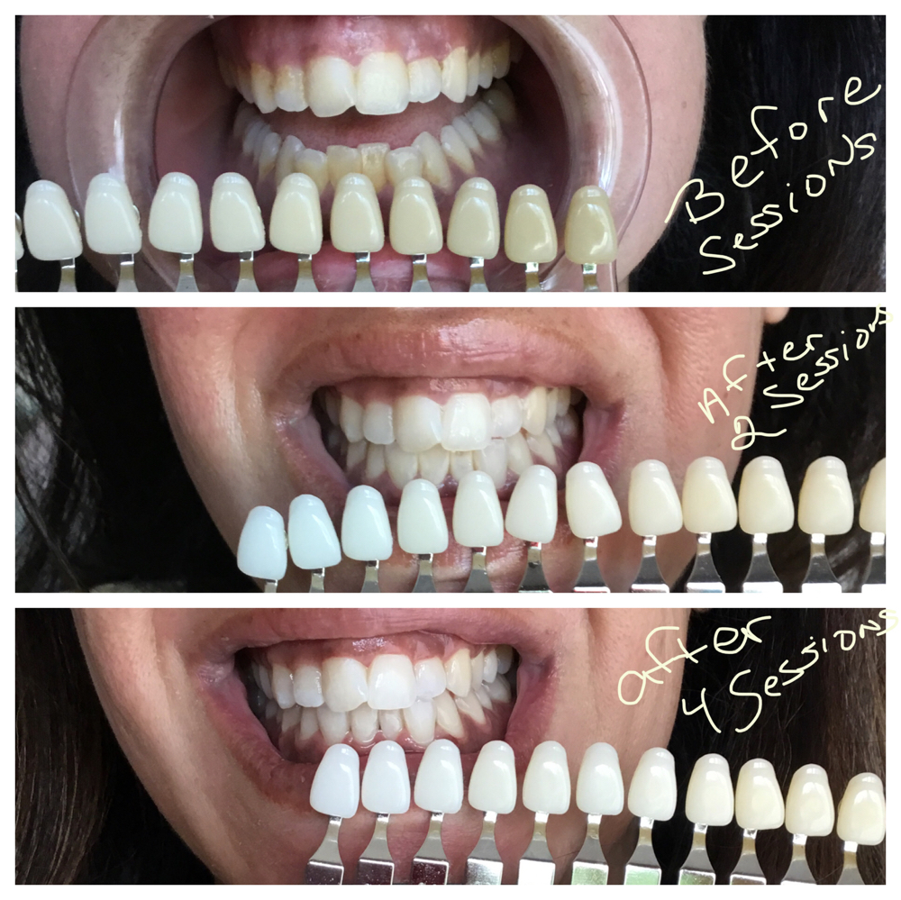50% off 2(30min) f/up Whitening Ses