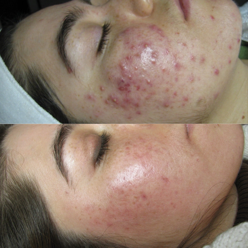 2 Week Face Reality Acne Bootcamp