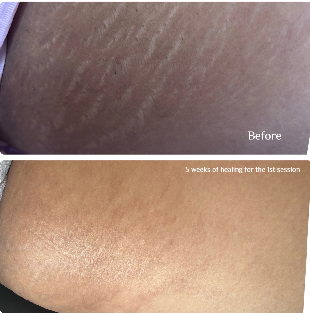 Stretch Marks Removal Inkless (ISR)