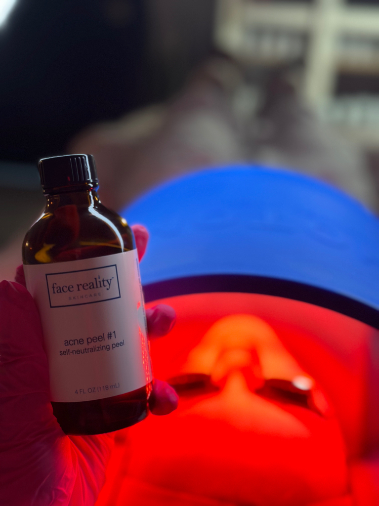 acne facial