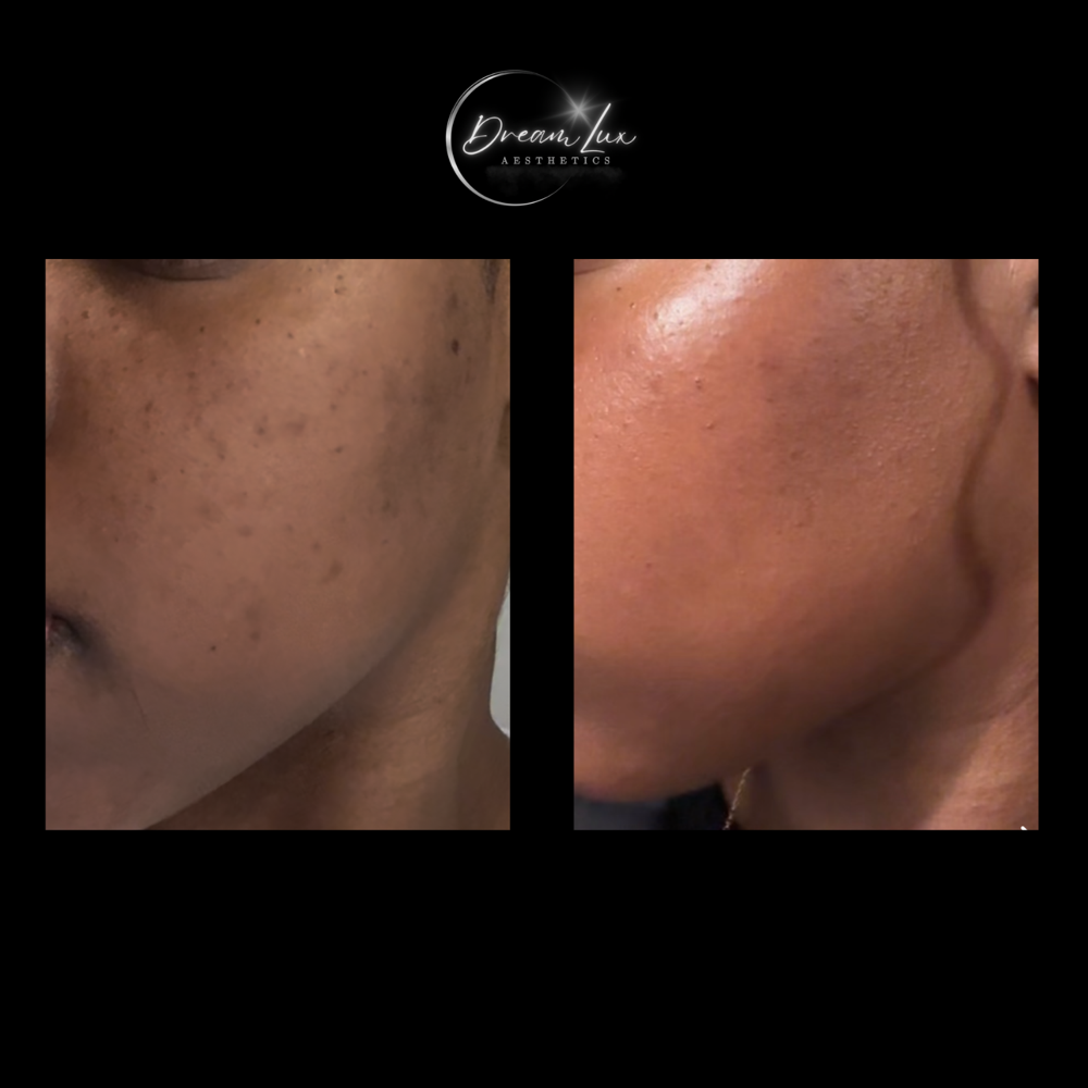 Medium Depth Chemical Peel