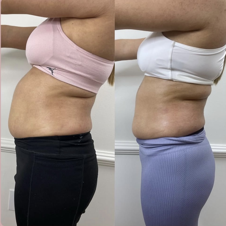 3 Body Sculpting Package