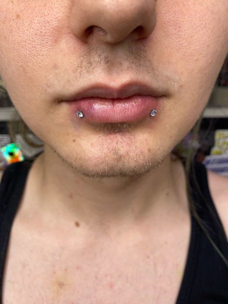 Snake Bites
