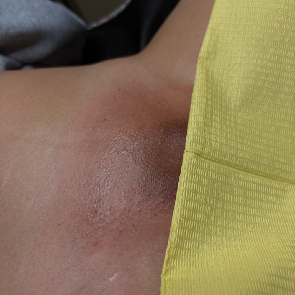 Brazilian Wax at 5StarEsthetics in Minneapolis, MN