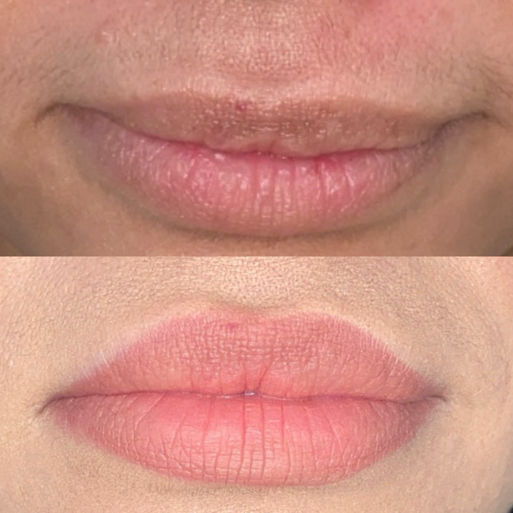 Lip Flip Using Botox