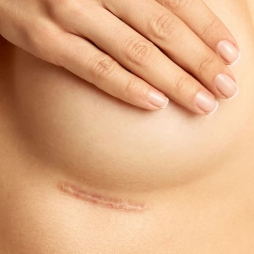 SCAR REMOVAL (MED) PKG OF 3 at WilKay Wellness & Aesthetics in Gilbert, AZ