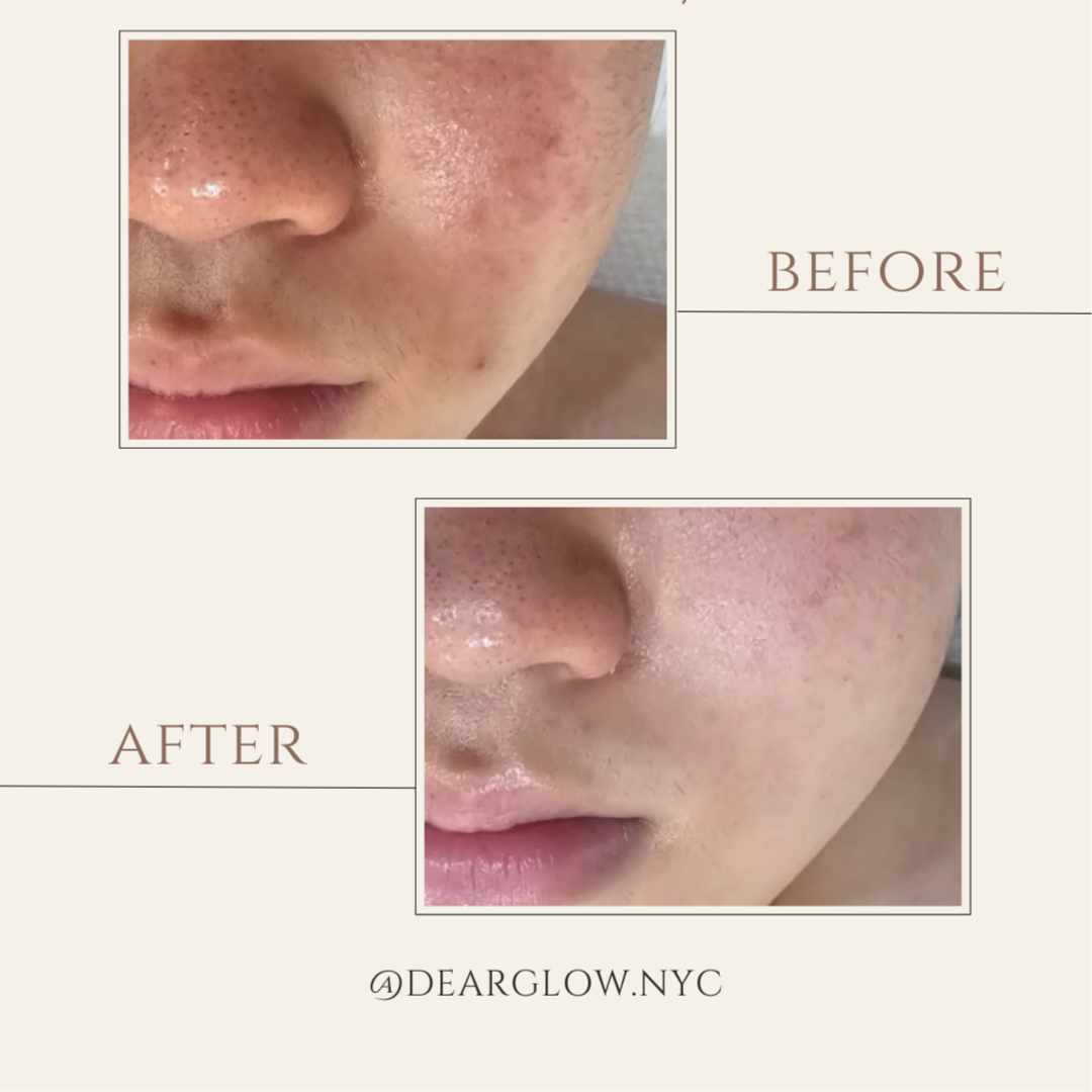 ACNE RESET: NEW CLIENT ONBOARDING at Dearglow Skin Studio in New York, NY