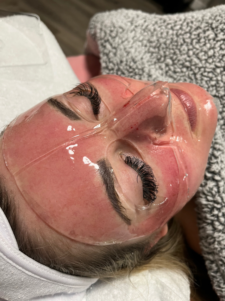 Micro-needle baby face treatment