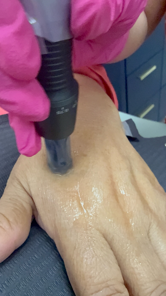 Hands Microneedling w/ HA at Revital Med Aesthetics & Wellness in Oceanside, NY