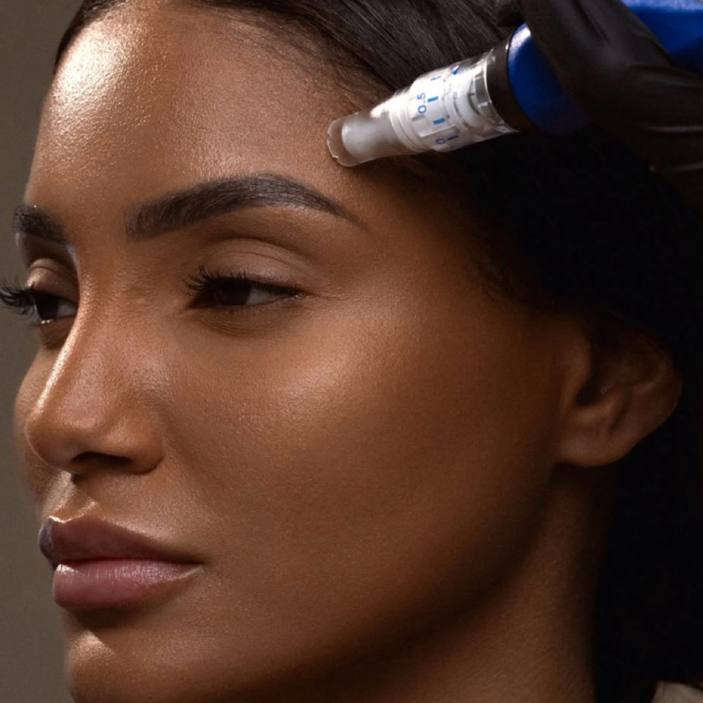 SkinPen Face Neck Chest at Bare Skin Aesthetics in Centennial, CO