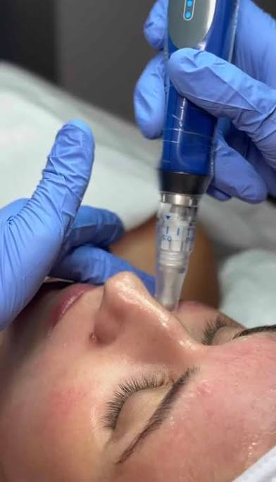 SkinPen Microneedling Face Glo