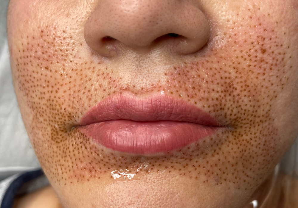 Lip Flip Butterfly Pattern Plasma