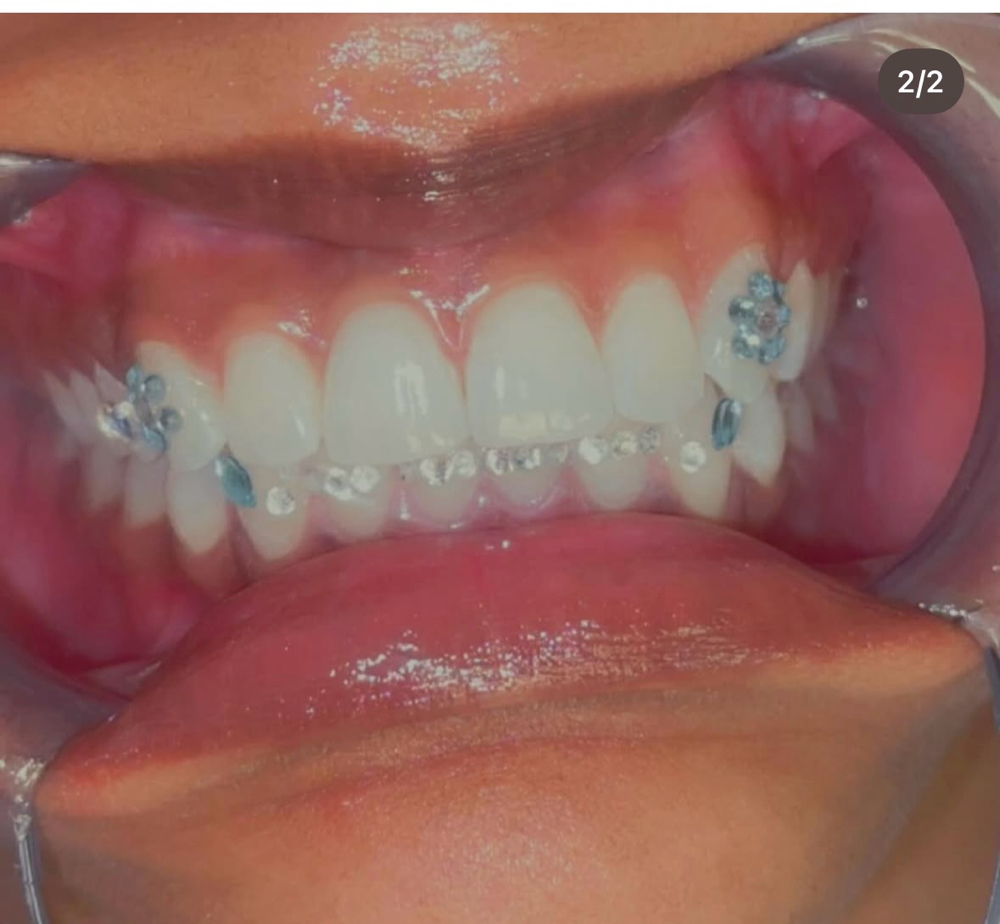 Tooth Gems Design- Per Tooth