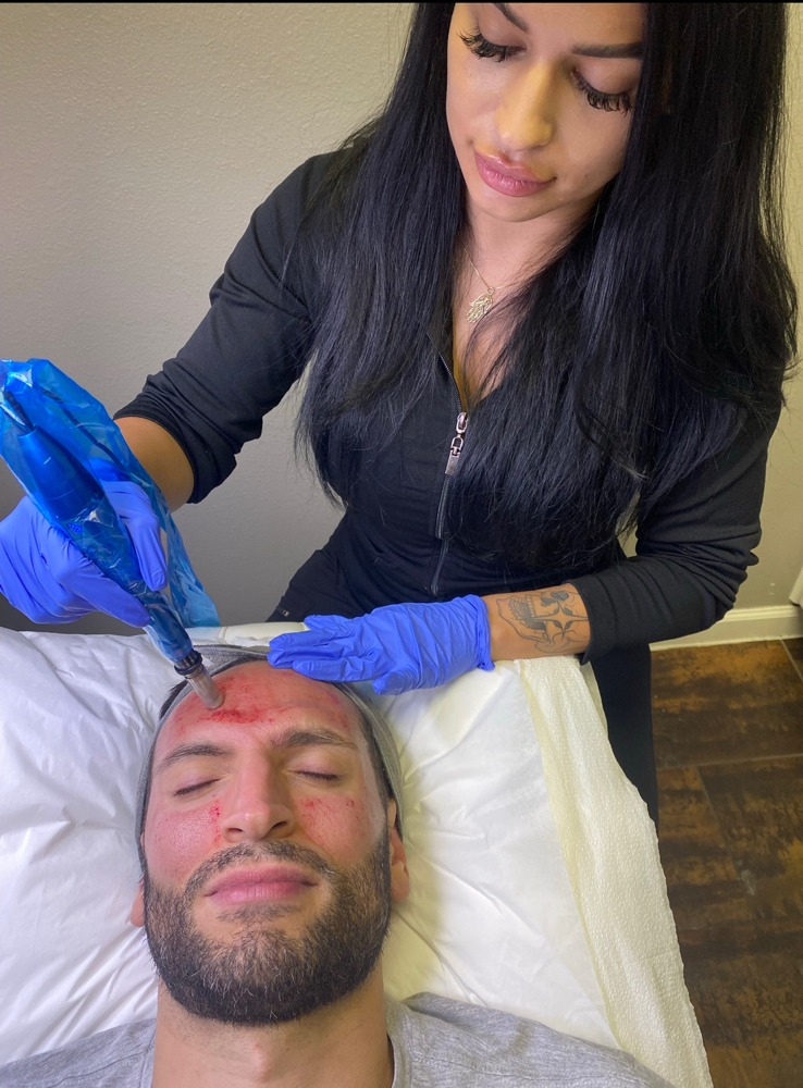 Mens 1/2 Face Microneedling
