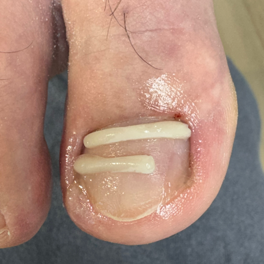 Ingrown Toenails Check Up at Southern Oregon PEDICURE CLINIC in Medford, OR