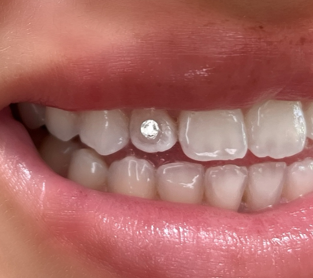 Tooth Gem Application- Luxe