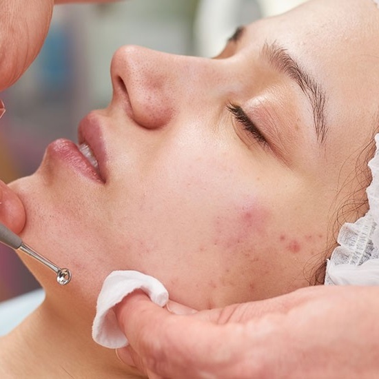 Acne-Erase Facial at Main St. Wax & Beauty Bar in Paris, IL