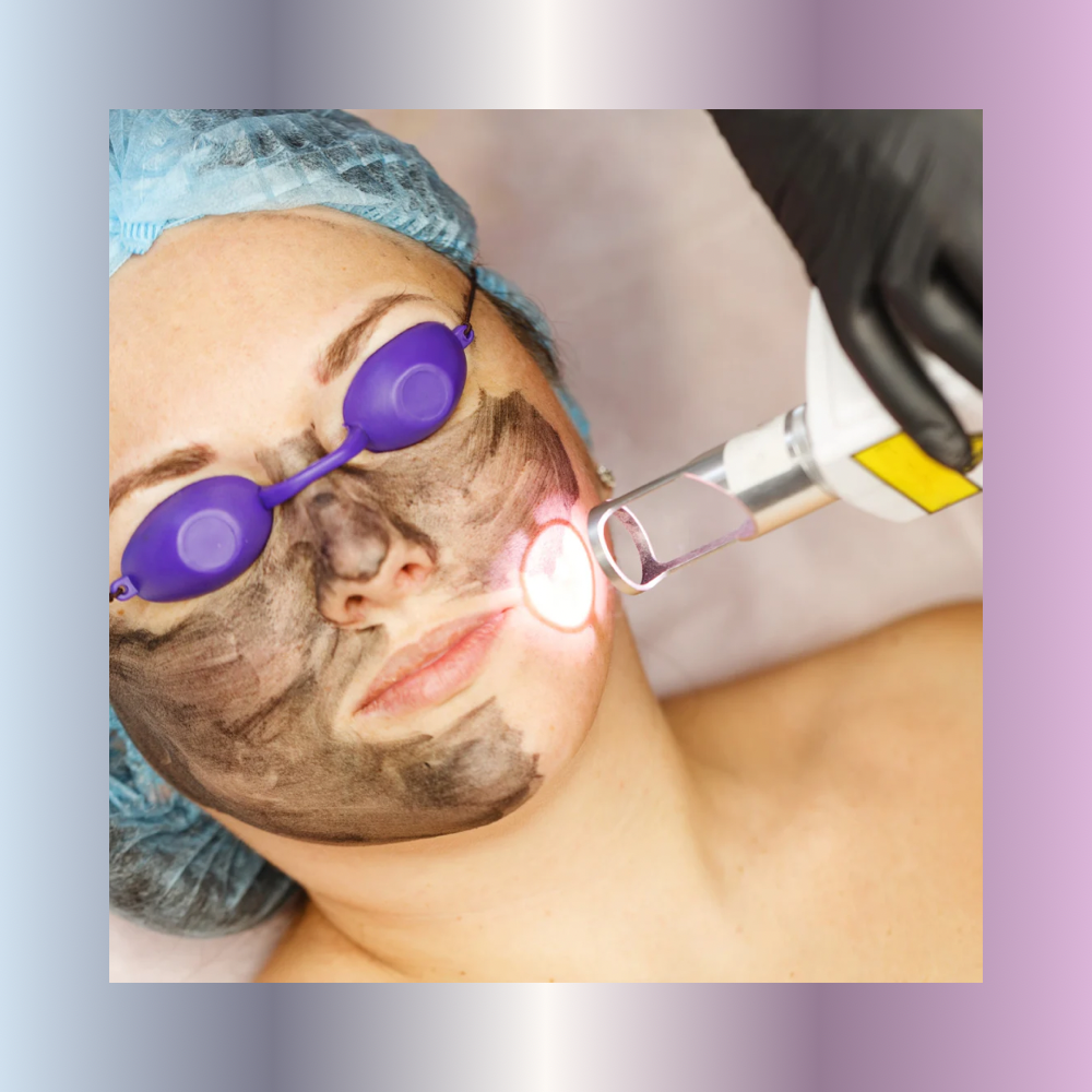 carbon laser facial