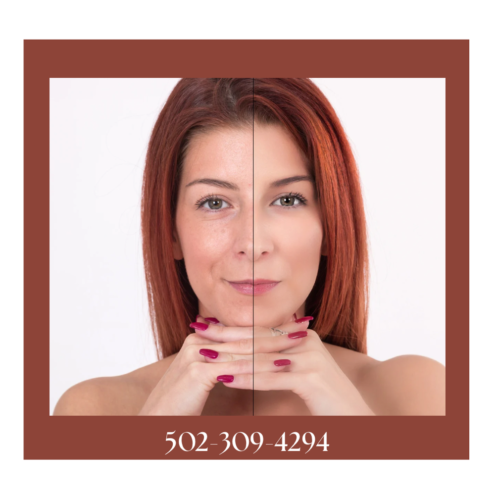 Collagen Stimulating Injections