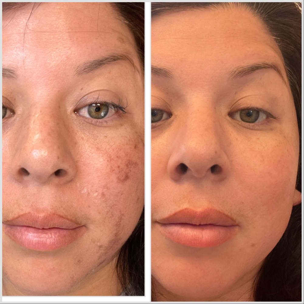 Hyperpigmentation Treatment