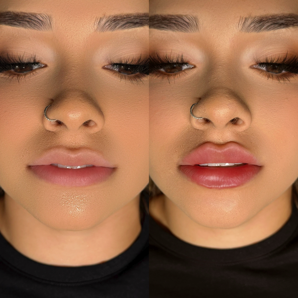 Russian Lips (Filler)