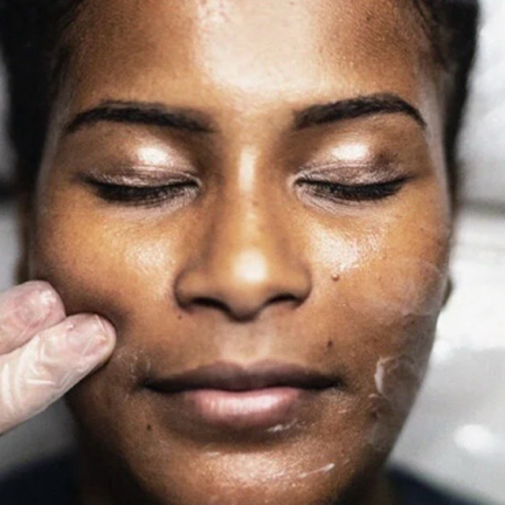 Jessner Peel with Facial Treatment