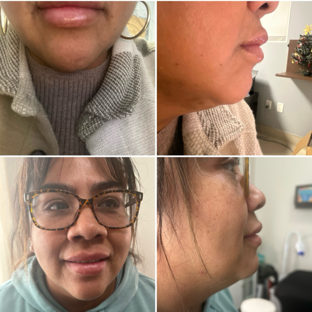 Kybella 3 Sessions at Kat Marie Aesthetics in Humble, TX