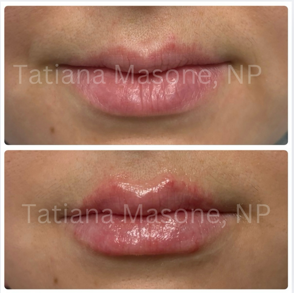 Lip Filler (1/2 Syringe)